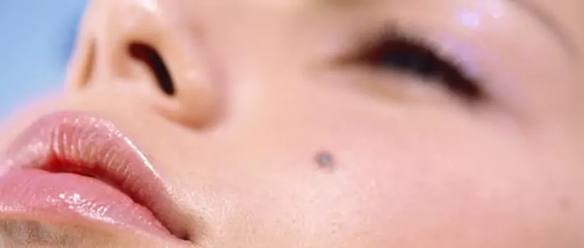 Biopsias y retiro de verrugas y lunares en piel de cara y cuello