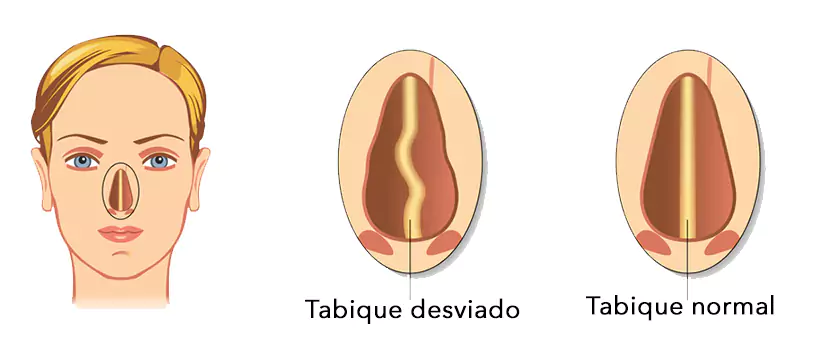 Desviación del tabique nasal