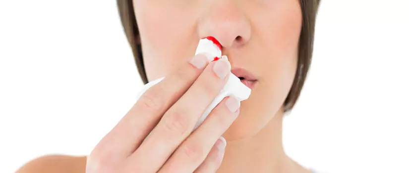 Epistaxis