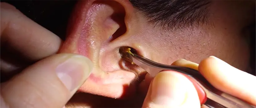 Tapones de cerumen